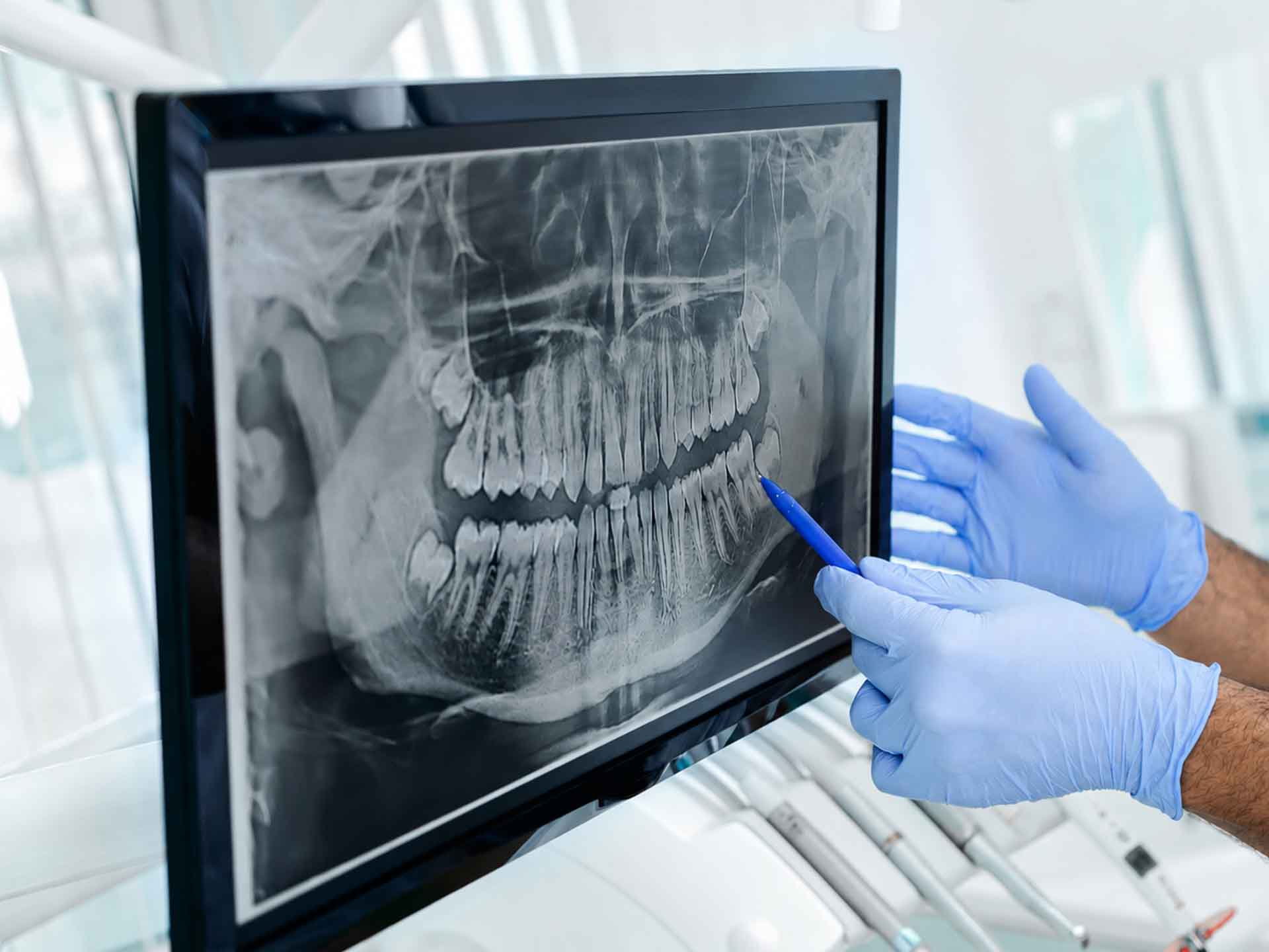 Dentist reviewing a panoramic dental X-ray for oral surgery treatment planning in Grand Blanc, Michigan